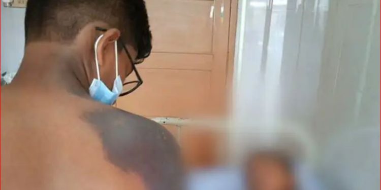 ഉപ്പിലിട്ടതു വില്‍ക്കുന്ന കടയില്‍ നിന്ന് രാസവസ്തു കുടിച്ചു ; കുട്ടികള്‍ക്കു പൊള്ളലേറ്റു