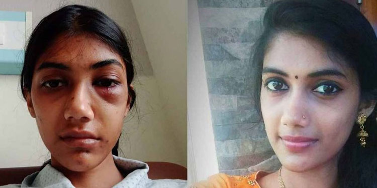 ഭർതൃമാതാവിന്റെ സുഹൃത്തിന്റെ ക്രൂരമർദനം ;  മുഖത്ത് ഇടിയേറ്റ യുവതി ഗുരുതരാവസ്ഥയിൽ
