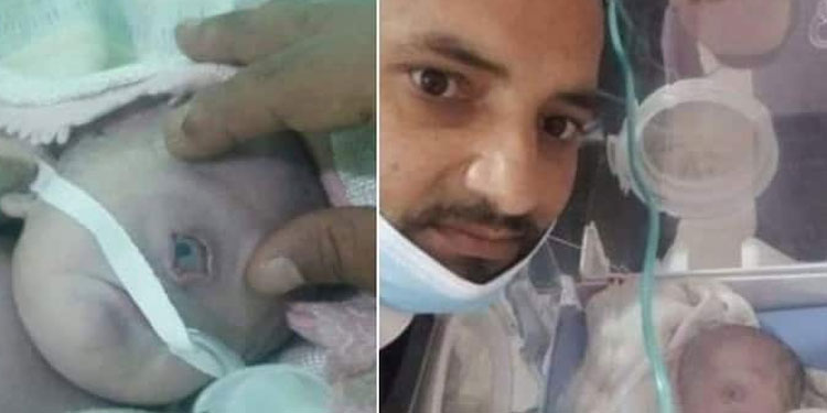 ഒരു കണ്ണുമായി ജനിച്ച ആണ്‍കുഞ്ഞ് പിറന്ന് ഏഴ് മണിക്കൂറിന് ശേഷം മരിച്ചു