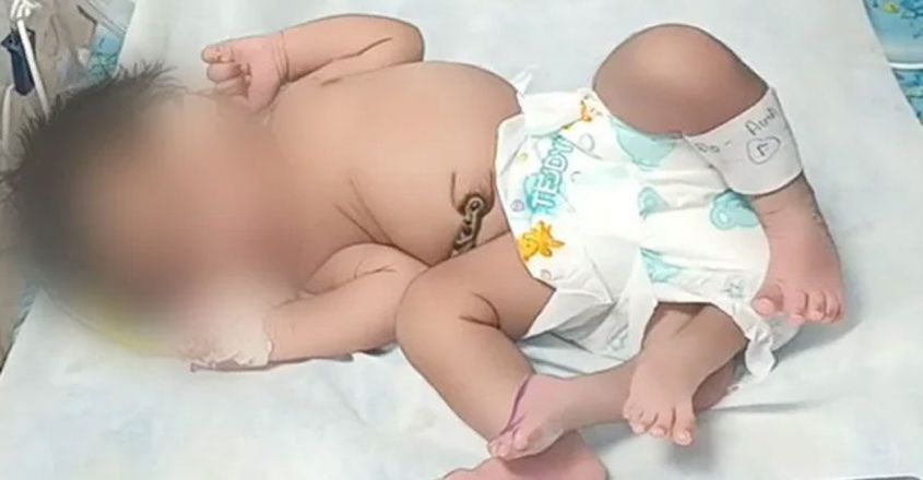 ഗ്വാളിയറിൽ നാല് കാലുകളുമായി പെൺകുഞ്ഞ് പിറന്നു; അപൂർവം