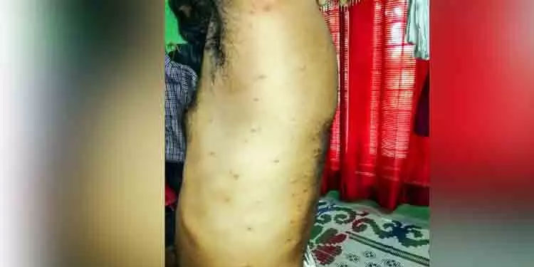 പേനിന്‍റെ ആക്രമണം; ആറ് കുടുംബങ്ങൾ നിരീക്ഷണത്തിൽ