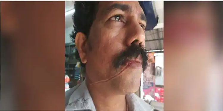 മരണക്കുരുക്കായി കേബിൾ, കൊച്ചിയിൽ വീണ്ടും കേബിൾ കുരുങ്ങി അപകടം, ബൈക്ക് യാത്രക്കാരന് പരിക്ക്