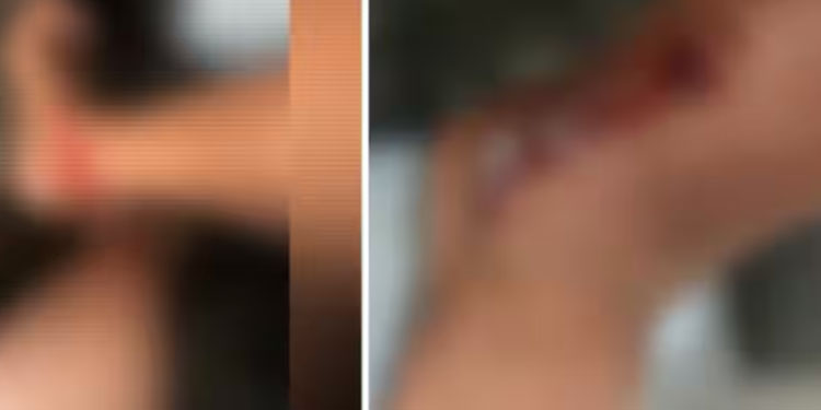 കുളിക്കാനിറങ്ങിയ 2 വിദ്യാർത്ഥികൾക്ക് നീർനായയുടെ കടിയേറ്റു; ആശുപത്രിയിൽ പ്രവേശിപ്പിച്ചു