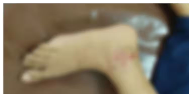 ബൈക്കിൽ പോകുമ്പോൾ പ്ലസ് ടു വിദ്യാർത്ഥിനിക്ക് തെരുവു നായയുടെ കടിയേറ്റു