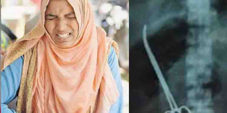ശസ്ത്രക്രിയക്കിടെ വയറ്റില്‍ കത്രിക കുടുങ്ങിയ സംഭവം; പ്രതികളുടെ അറസ്റ്റ് ഉടന്‍