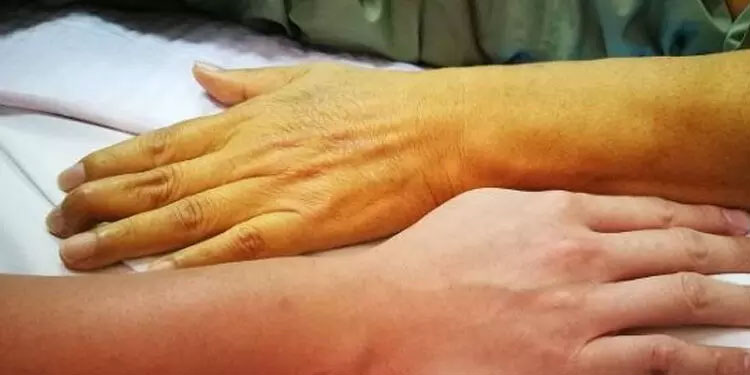 മലപ്പുറത്ത് ഹെപ്പറ്റൈറ്റിസ് രോഗ ബാധ: രണ്ട് മരണം, ജാഗ്രത വേണമെന്ന് ആരോഗ്യ വകുപ്പ്