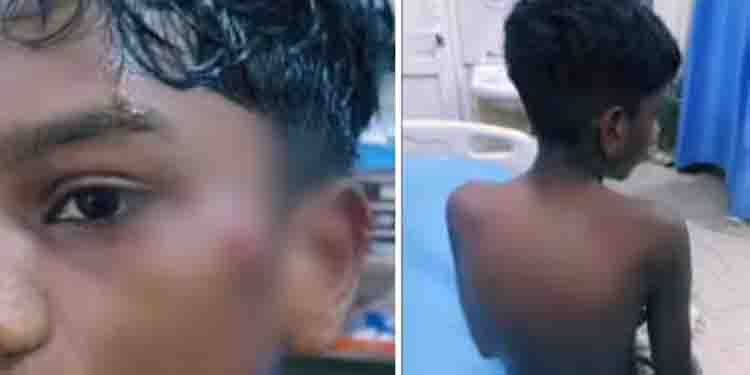 വീണ്ടും റോട്ട് വീലർ ആക്രമണം; ദേഹമാസകലം പരിക്കുകളോടെ 12 വയസുകാരൻ ആശുപത്രിയിൽ
